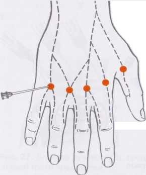 Блокада пальцевых нервов по Усольцевой Блокада пальцевых нервов по Усольцевой